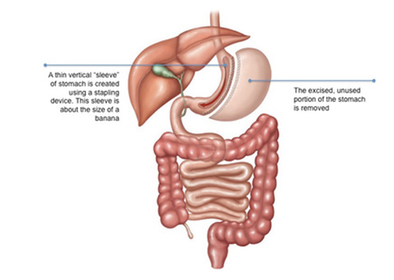sleeve-gastrectomy-img
