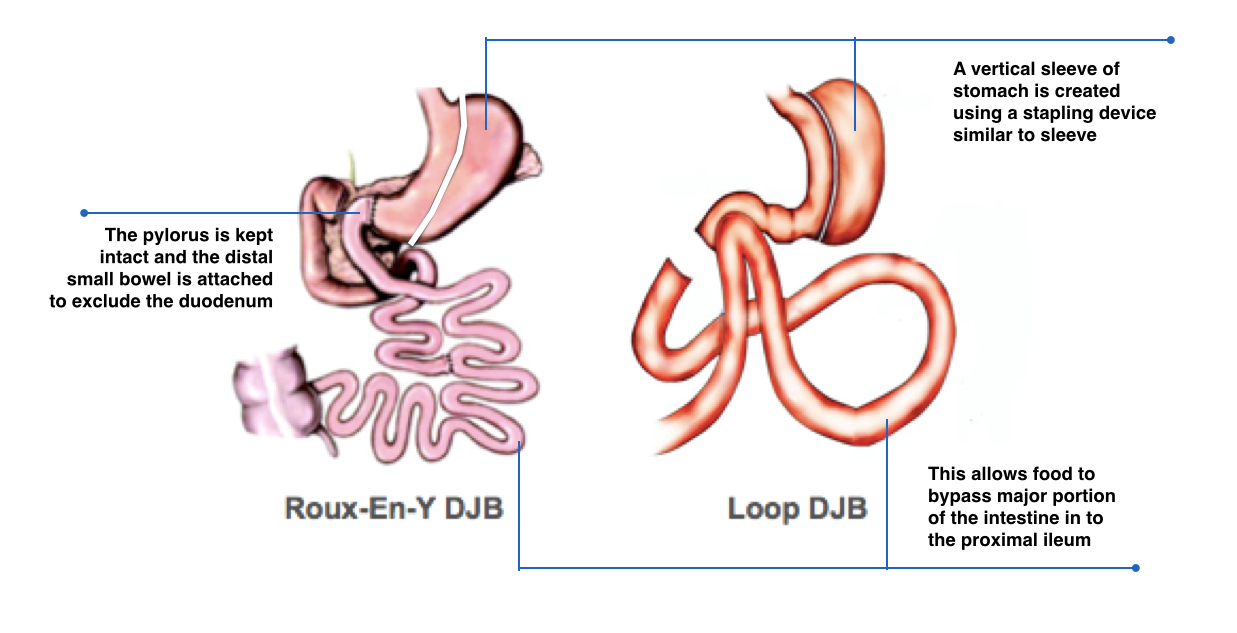 Duodeno-Jejunal Bypass
