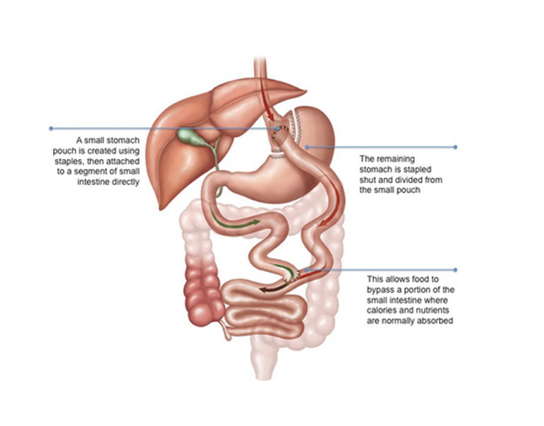 Roux-En-Y Gastric Bypass